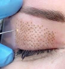 Marketed for eyelid lifts and wrinkle reduction, plasma pens are not approved for sale in Canada.