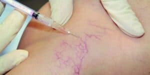Sclerotherapy Workshops Offer Precision Training